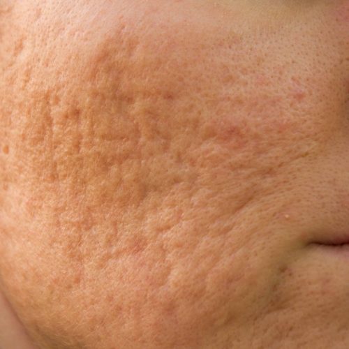 acne_scars1