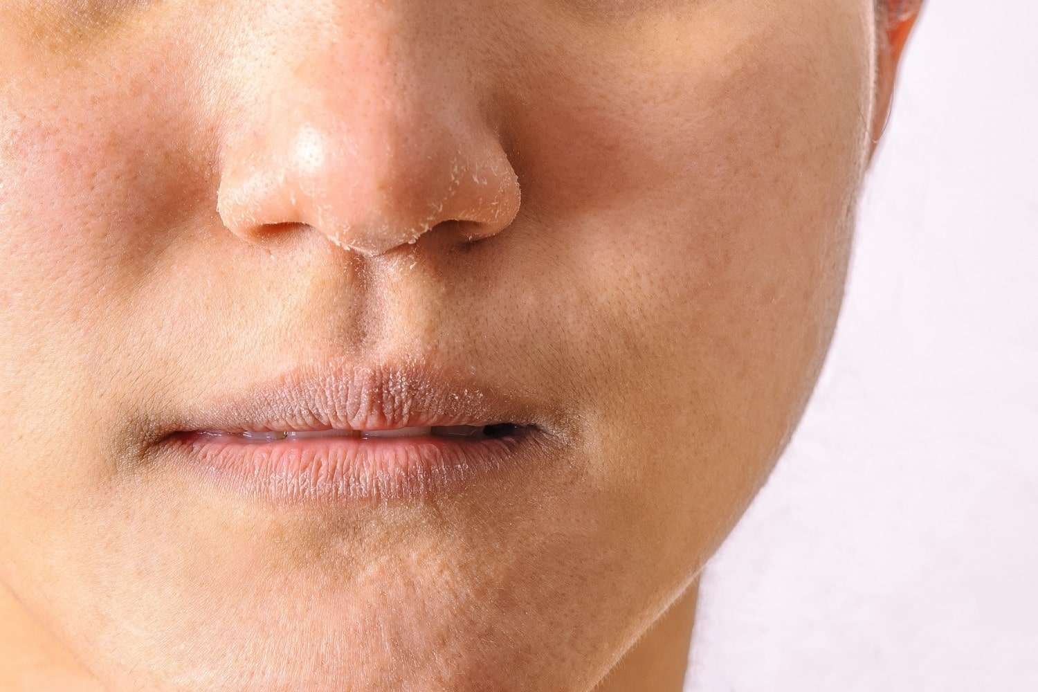 person-with-dry-skin-on-their-lips-and-nose
